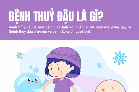 Những điều cần biết về bệnh thủy đậu