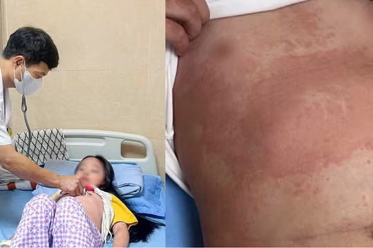 Phú Thọ: Nhiều trẻ nhập viện vì ban nhiễm khuẩn