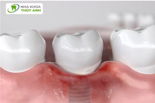 Trồng răng implant giá rẻ thủ phạm tàn phá sức khỏe răng miệng