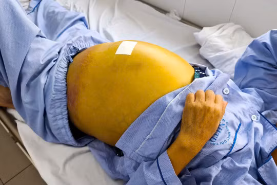 Phát hiện viêm gan B muộn, 2 bệnh nhân gặp bệnh lý nguy hiểm về gan