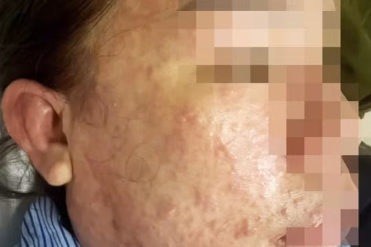 Dùng thuốc giảm mỡ bụng và collagen trôi nổi, người phụ nữ suýt mất mạng