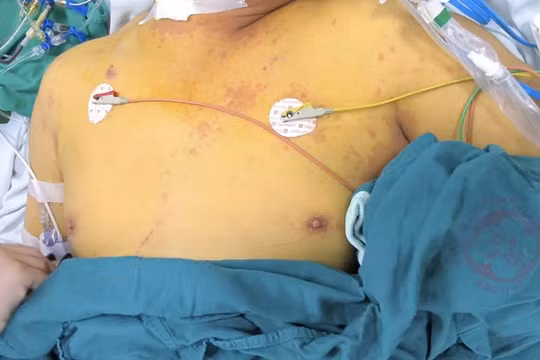 Sau bão lũ, nguy cơ tử vong từ xoắn khuẩn Leptospira tăng cao
