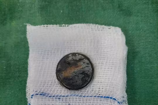 Bác sĩ cảnh báo nguy cơ tử vong do nhiều trẻ nuốt, nhét pin 'cúc áo'