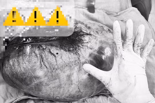 Bóc tách thành công khối u buồng trứng nặng 8kg ở bé gái 13 tuổi