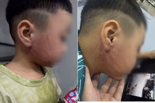 Xác minh vụ bé 4 tuổi nghi bị cô giáo đánh bầm tím mặt
