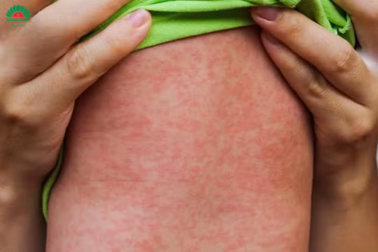 Sởi vào chu kỳ bùng phát 5 năm 1 lần: Cảnh báo nhiều trẻ biến chứng nặng