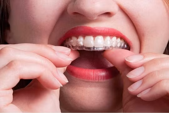 Niềng răng invisalign giá bao nhiêu tại Nha khoa Đăng Lưu?