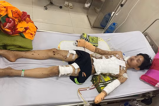 Pháo tự chế phát nổ, nam sinh mất bàn tay và tổn thương nghiêm trọng