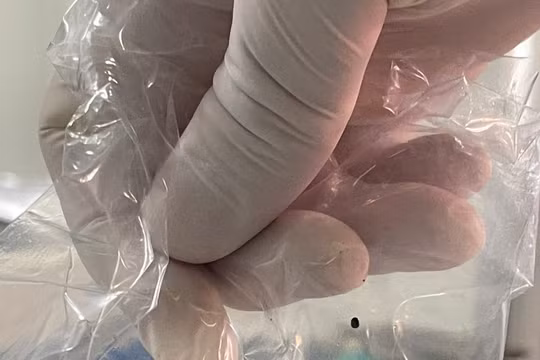 Lấy hàng trăm viên sỏi trong bụng người phụ nữ bị sỏi mật