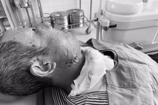 Bệnh nhân suýt tử vong vì tự đốt nhiệt chữa đau răng