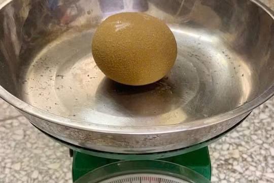 Người đàn ông mang viên sỏi bàng quang bằng quả cam suốt nhiều năm