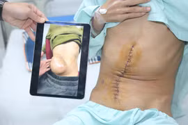 Thoát 'án tử' nhờ điều trị đa mô thức đem hy vọng sống cho bệnh nhân ung thư gan giai đoạn cuối