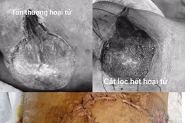Thanh niên 17 tuổi nguy kịch vì nhiễm khuẩn nặng từ một nốt mụn nhỏ