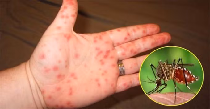 Bệnh do virus Zika gây ra là bệnh có chung véc tơ truyền với sốt xuất huyết. Virus Zika có thể làm tổn thương não bộ, tiêu diệt các tế bào não bộ đang phát triển, gây dị tật đầu nhỏ ở trẻ sơ sinh do truyền từ mẹ sang con. Ảnh TL.