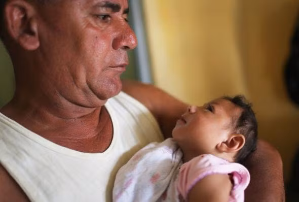 Trẻ sơ sinh mắc bệnh đầu nhỏ do virus Zika. ẢNh: TL