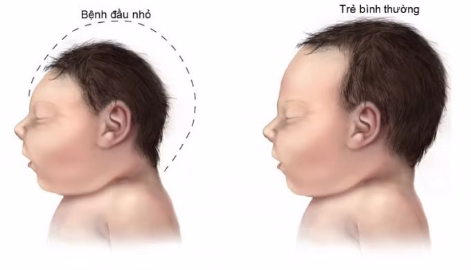 Bệnh Zika có thể gây bệnh teo não ở trẻ sơ sinh (ảnh nguồn internet).