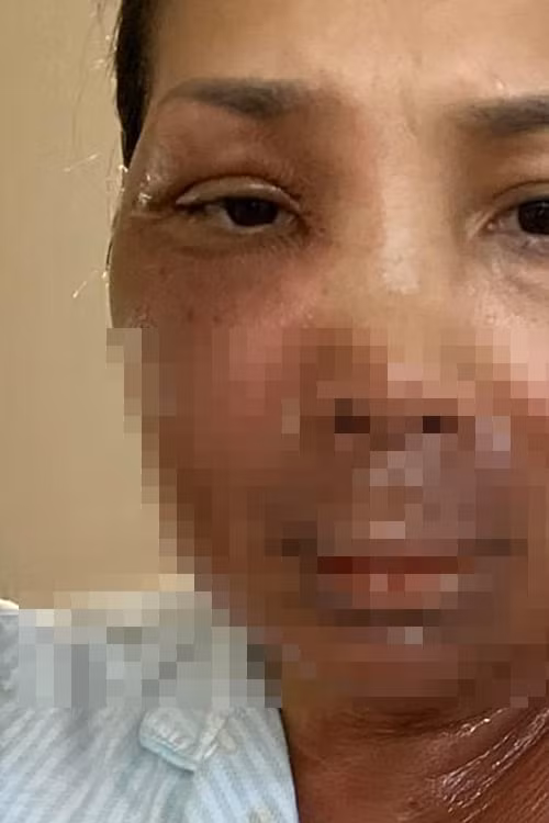 Hồng Ngọc đăng ảnh chụp&nbsp;rõ vết thương đang gánh&nbsp;chịu để khuyên mọi người cần hành động cẩn thận để tránh xảy ra tai nạn tương tự.