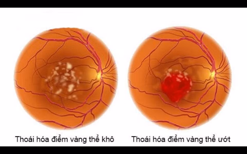 Có hai loại thoái hóa điểm vàng là thoái hóa điểm vàng thể khô và thoái hóa điểm vàng thể ướt.