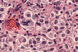 Vắc xin ung thư cá nhân hóa mRNA hứa hẹn nhiều đột phá