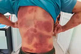 Tự ý dùng thuốc điều trị viêm gan B, một người bị nhiễm độc toàn thân