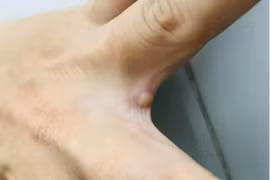 TP. HCM có ca đậu mùa khỉ thứ 2