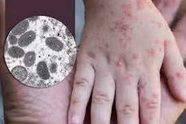 Bệnh nhân mắc đầu mùa khỉ phải điều trị cách ly