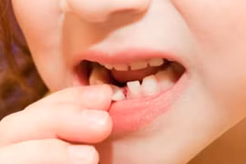 Mơ thấy rụng gãy răng lành hay dữ? Con số may mắn liên quan