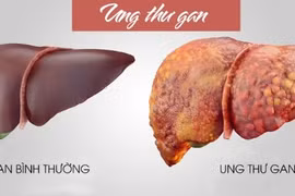 Ung thư gan điều trị bằng hóa chất hiệu quả thấp