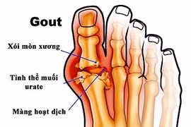 Những dấu hiệu đầu tiên và đặc trưng của bệnh gout