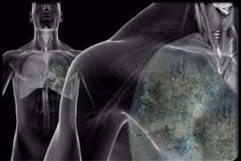 Những điều cần biết về bệnh ung thư di căn màng phổi