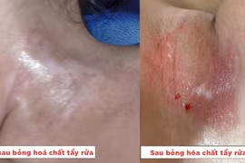 Cảnh báo bị bỏng do hóa chất tẩy dầu mỡ