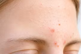 5 dấu hiệu lạ trên gương mặt là điềm báo phá tài
