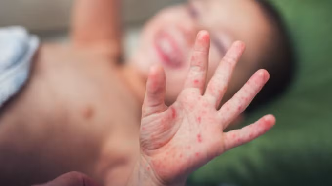 Số ca mắc tay chân miệng vào Bệnh viện Nhi đã tăng gấp 6 lần năm trước. Ảnh minh họa