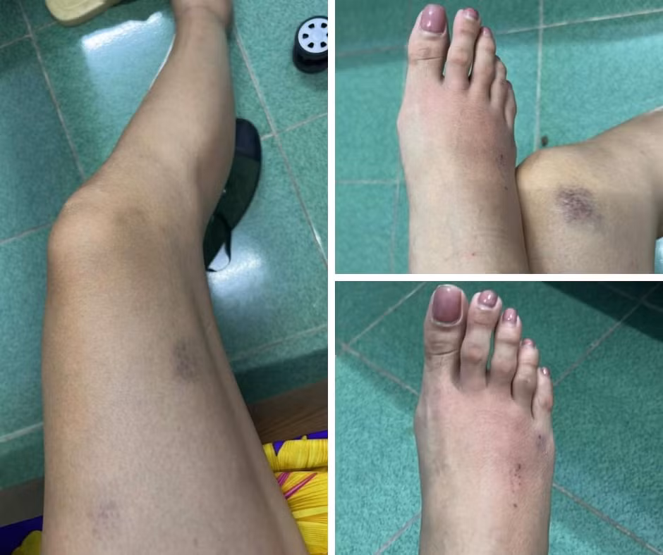 sieu mau hoang yen khien khan gia lo lang khi lo bi thoai hoa khop hinh 2