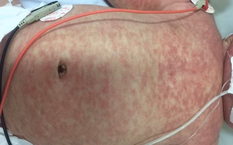 ha nam chu dong phong chong benh soi rubella giam thieu nguy co bung phat dich hinh 1