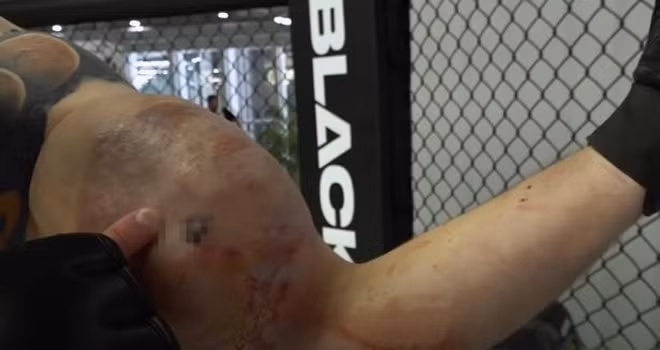 luc sy co bap tay 60cm gap chan thuong dang so khi tro lai san dau vo mma hinh 3