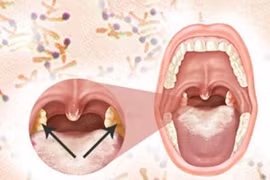 Cách nhận biết và phòng ngừa bệnh bạch hầu