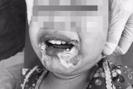 Yên Bái: Bé gái 2 tuổi hoại tử miệng vì cắn phải dây điện