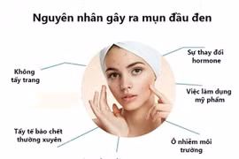 Cách trị mụn đầu đen tại nhà dễ dàng và hiệu quả nhất