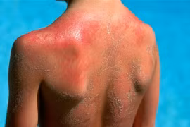 Mẹo phòng tránh bị tổn thương da khi đi nắng