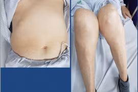 Lạm dụng Corticoid nhiều bệnh nhân biến chứng nặng