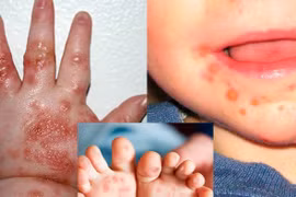 Phòng bệnh tay chân miệng: Cần chú ý điều gì ?