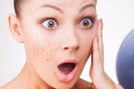 Những lưu ý khi trang điểm giúp bạn tránh bị nổi mụn