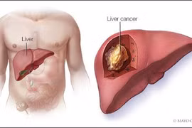 Uống rượu, hút thuốc vô tội vạ, đàn ông Việt coi chừng ung thư gan, phổi
