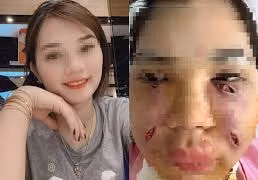 Biến chứng của cấy mỡ tự thân, nhiều người trở thành "dị nhân"