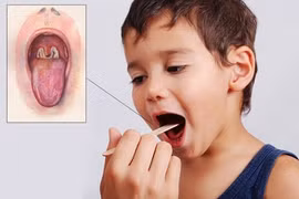 Những lưu ý để phòng tránh bệnh bạch hầu