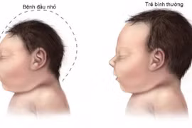Chuyên gia nói gì về bệnh nhân mới mắc Zika tại Đà Nẵng?