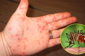 CDC Đà Nẵng thông tin về bệnh nhân mắc virus Zika