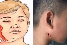 "Vi khuẩn ăn thịt người" - Căn bệnh này là gì và nguy hiểm như thế nào?