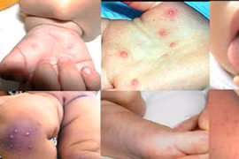 Lâm Đồng: Bùng phát bệnh tay chân miệng ở một trường mầm non